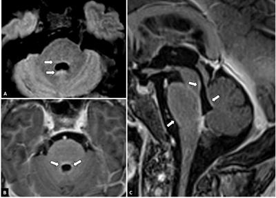 Case report: Psychosis with catatonia in an adult man: a presentation of neurosarcoidosis
